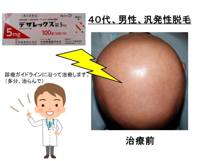 円形脱毛症　病院